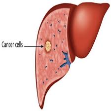 liver-cancer-treatments
